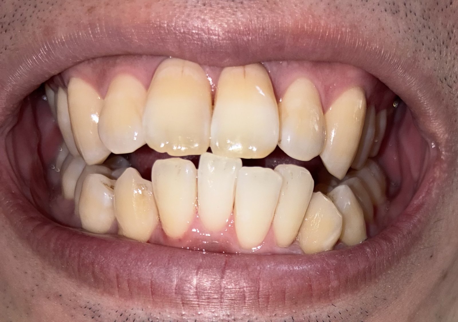ブリリアントモアWを1回使った後の歯(正面・口を開けた状態)を撮影した写真