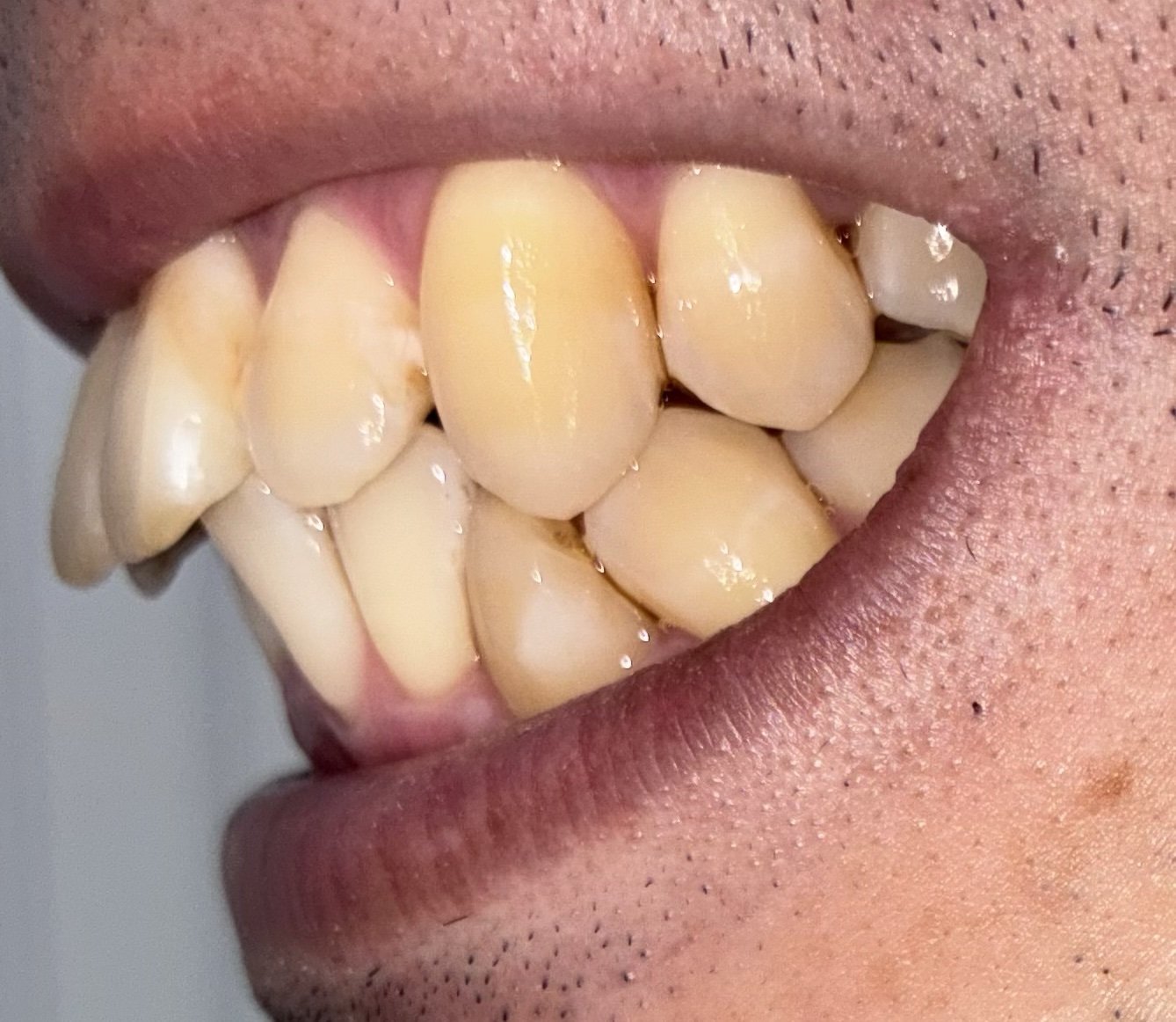 ブリリアントモアWを1回使った後の歯(横から)を撮影した写真