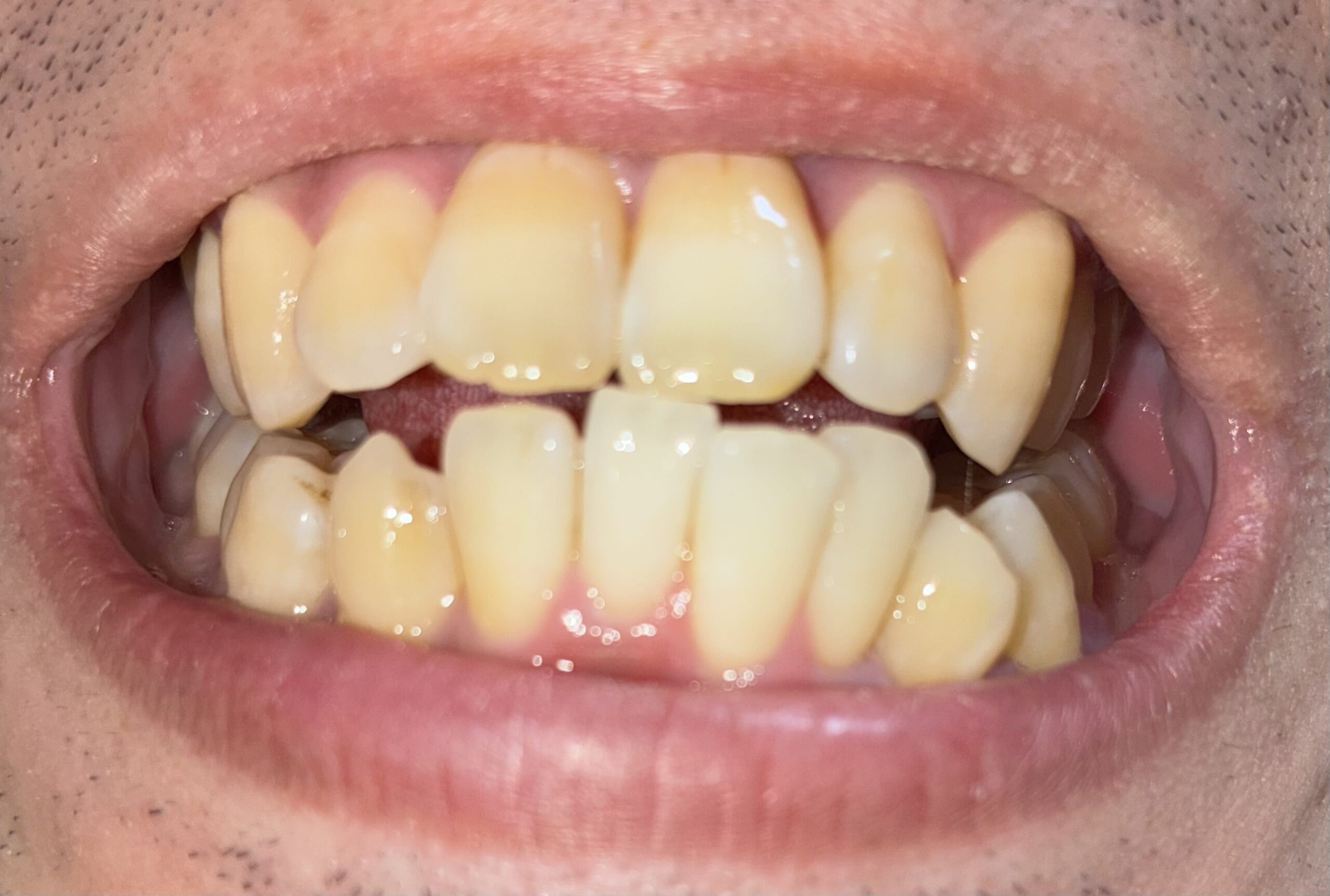 ブリリアントモアWを1週間使った後の歯(正面・口を開けた状態)を撮影した写真