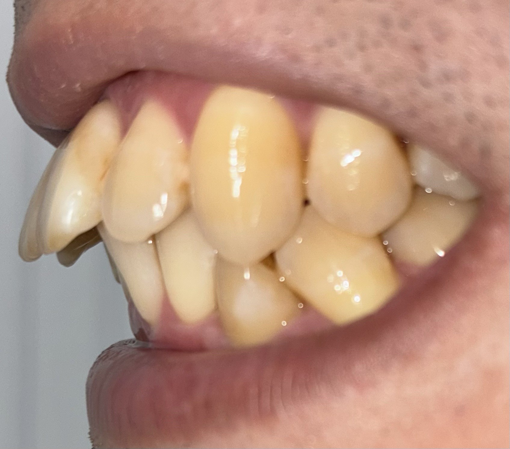 ブリリアントモアWを1週間使った後の歯(横から)を撮影した写真